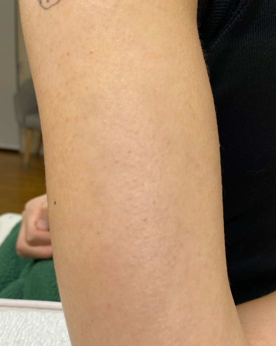 Same tattoo after laser removal sessions